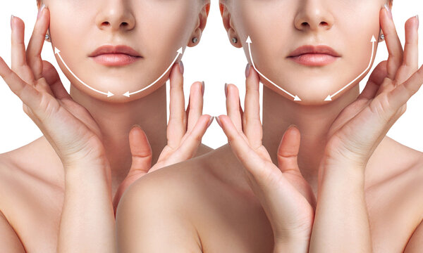 Woman before and after cheekbones shape correction.