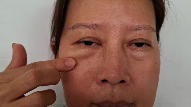 A woman uses her fingers to wipe away wrinkles on her face under the eyes.
