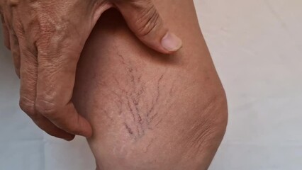 A middle-aged woman has varicose veins on her thighs.
