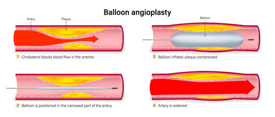 Steps of balloon angioplasty vector. Balloon in The Treatment of Coronary Artery Disease. Treatment of clogged arteries.