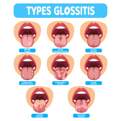 Types Glossitis vector illustration