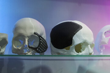 Layout of the human skull with implants made using 3D printing technology