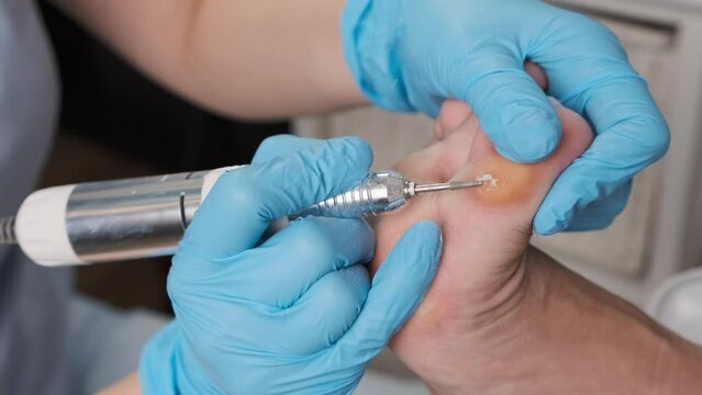 Professional removing a callus on a womans foot by electric drill