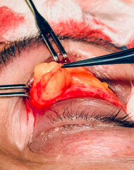 photo of suturing the upper eyelid after blepharoplasty surgery