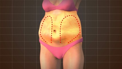 Waist fat reduction medical animation