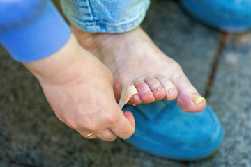 Female hands applying a bandage to a callus on a foot with damaged toenails