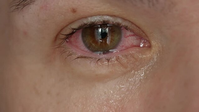 Red eye of a crying man