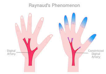 Raynaud phenomenon. Cold hands syndrome. usually Fingers and toes. Comparison ice, limb disease. Condition that causes blood vessels going to certain. Vector illustration