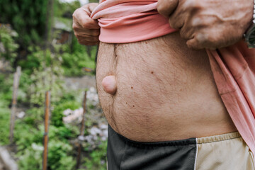 An adult elderly man shows a large umbilical hernia on his abdomen. Close-up photo, disease concept.