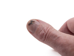 Thumbnail injury starting to heal and old nail broken and damagednwith a hole.