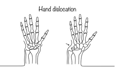 Hand dislocation