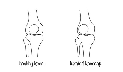 Patella luxation