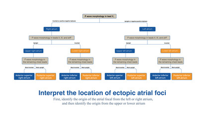 On a 12 lead electrocardiogram, analyzing the morphology and polarity of ectopic P-waves can determine the approximate anatomical location of ectopic atrial foci.
