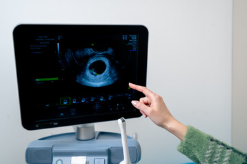 in the clinic gynecological office screening monitor gestational age female hand points to the fetus