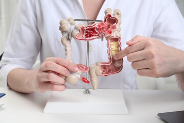 Doctor showing model of large intestine at white table in clinic, closeup