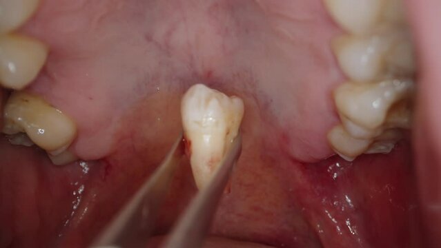 Man's Wisdom Tooth Has Been Extracted and Is Being Pulled Out of Mouth With Tweezers.