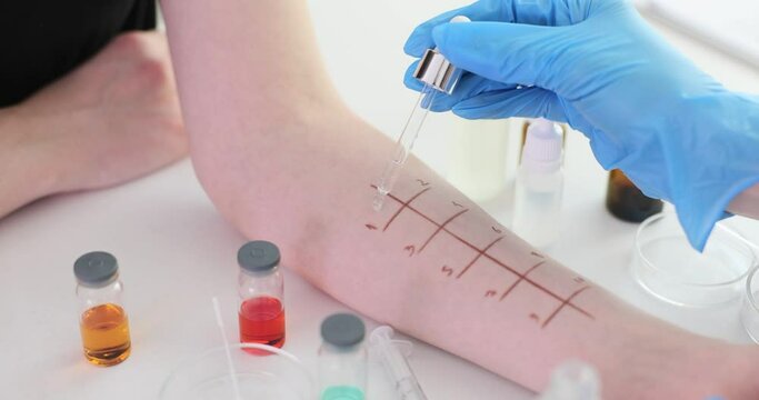 Skin prick test for allergies on a patient's hand in a medical laboratory