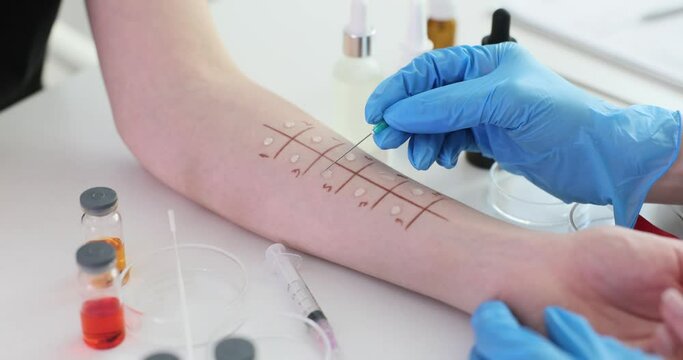 Skin prick test for allergies on a patient hand in clinic