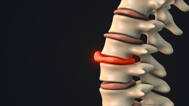 Bulging disc in the human spine