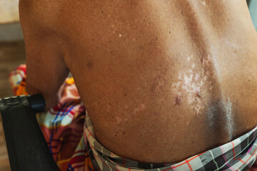 Fototapeta premium An old Asian man had a skin disease on his back, ringworm, fungus, and after healing, he had a prominent scar on his back.