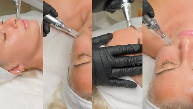 Close-up portrait of a beautiful aged woman during microneedling with dermapen from a beautician. Video collage.