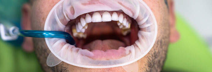 The dentist treats the patient's teeth, photo of the open mouth of the patient who came to the...