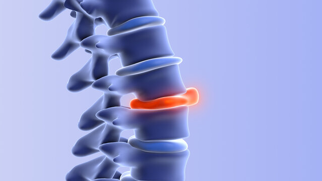 Human spine with bulging disc