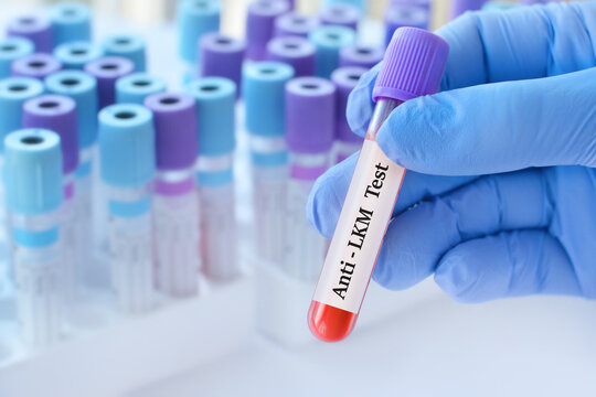 Doctor holding a test blood sample tube with Anti LKM test on the background of medical test tubes with analyzes.