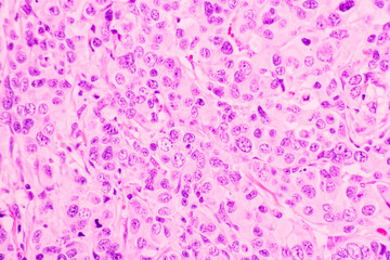 Backgrounds of human cells tissue of lung human under the microscope in pathology lab.View in microscopic of ductal cell carcinoma, adenonocarcinoma from human breast cancer, tissue section by H and E