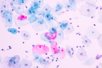 Abnormal squamous epithelial cells view in microscopy.HPV criteria for pap smear slide cytology and...