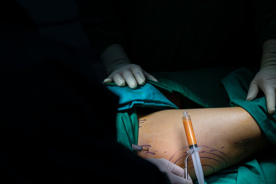 Female patient with marks on skin lying on medical bed while doctor preparing tools.Plastic surgeon sewing up breast of female patient after inserting implants in operating room.