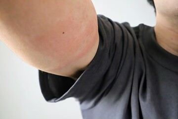 肌荒れした日本人男性の腕