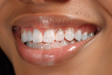 Close-up of a smiling person wearing an invisible aligner, symbolizing the seamless blend of treatment and lifestyle  