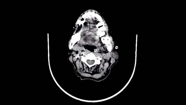 cerebral embolism  infarction  ct scan  
