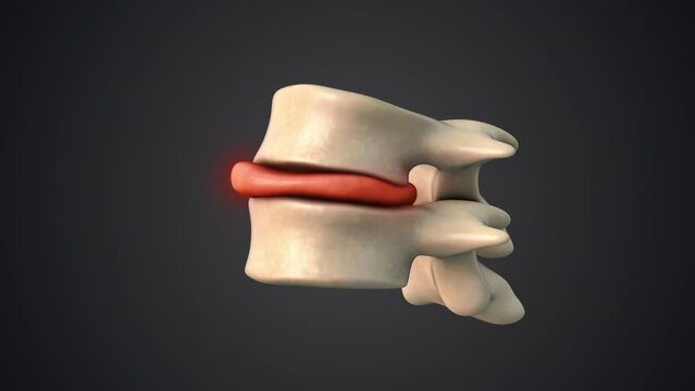 Spine affected by a bulging disc