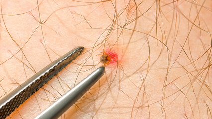 Professional dermatologist using specialized tweezers to remove embedded tick from patient's skin....