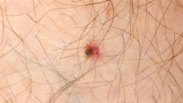 Close-up view of bee sting on human skin causing allergic reaction with visible redness and swelling. Medical and health awareness of insect sting allergy and first aid treatment.