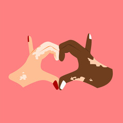vector Illustration of two hands forming a heart with both hands suffering from vitiligo