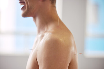 Acupuncture, man and treatment of body for healthcare, healing muscle or relief from back pain....