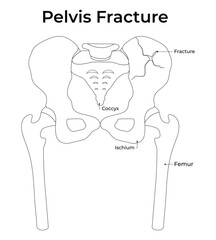 Pelvis Fracture Science Design Vector Illustration Diagram