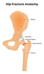 Hip Fracture Anatomy Science Design Illustration Diagram