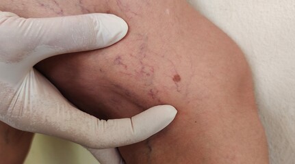 close up of a patient circulation of blood, spider and crack, varicose veins on the leg, health...