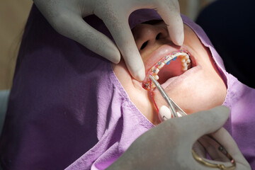 Close up dentist hand putting orthodontic braces on female patient teeth.Woman with dental braces...