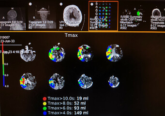 Brain Perfusion Scan - Right Middle Cerebral Artery Occlusion