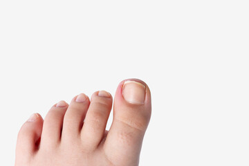ingrown toenail occurs, white background