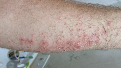 Poison Ivy rash and infection on Forearm