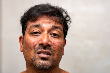 closeup face of a man who having varicella blister or chickenpoxor Monkeypox new disease dangerous over the world.