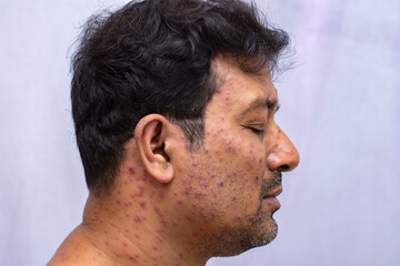 Obraz premium closeup side face of a man who having varicella blister or chickenpox or Monkeypox new disease dangerous over the world.