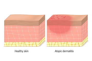 Atopic dermatitis symptoms vector. Cross-section of human skin with eczema. Comparison between healthy skin and atopic dermatitis.