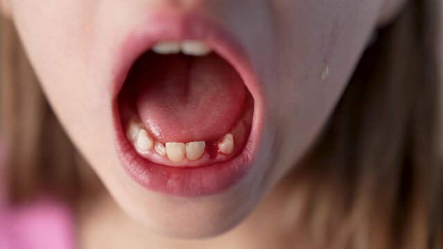 Portrait of a girl crying after pulling out her baby teeth, close-up.